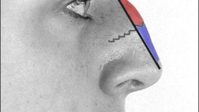 rinoplastica profilo