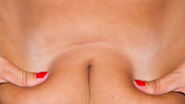 liposcultura non chirurgica