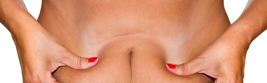 Liposuzione: non solo una questione di estetica